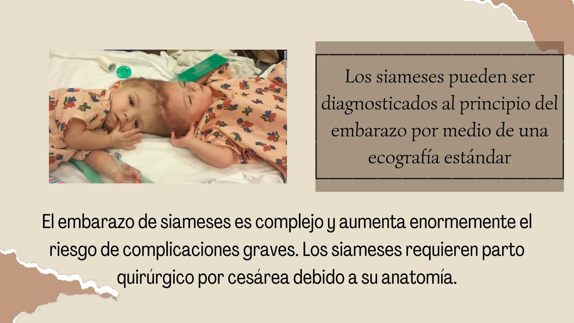 # HERMANOS

# SIAMESES

Septimo - 2022 # ¿QUE SON LOS HERMANOS
SIAMESES?

Los gemelos unidos son dos bebés que nacen conectados
físicamente.