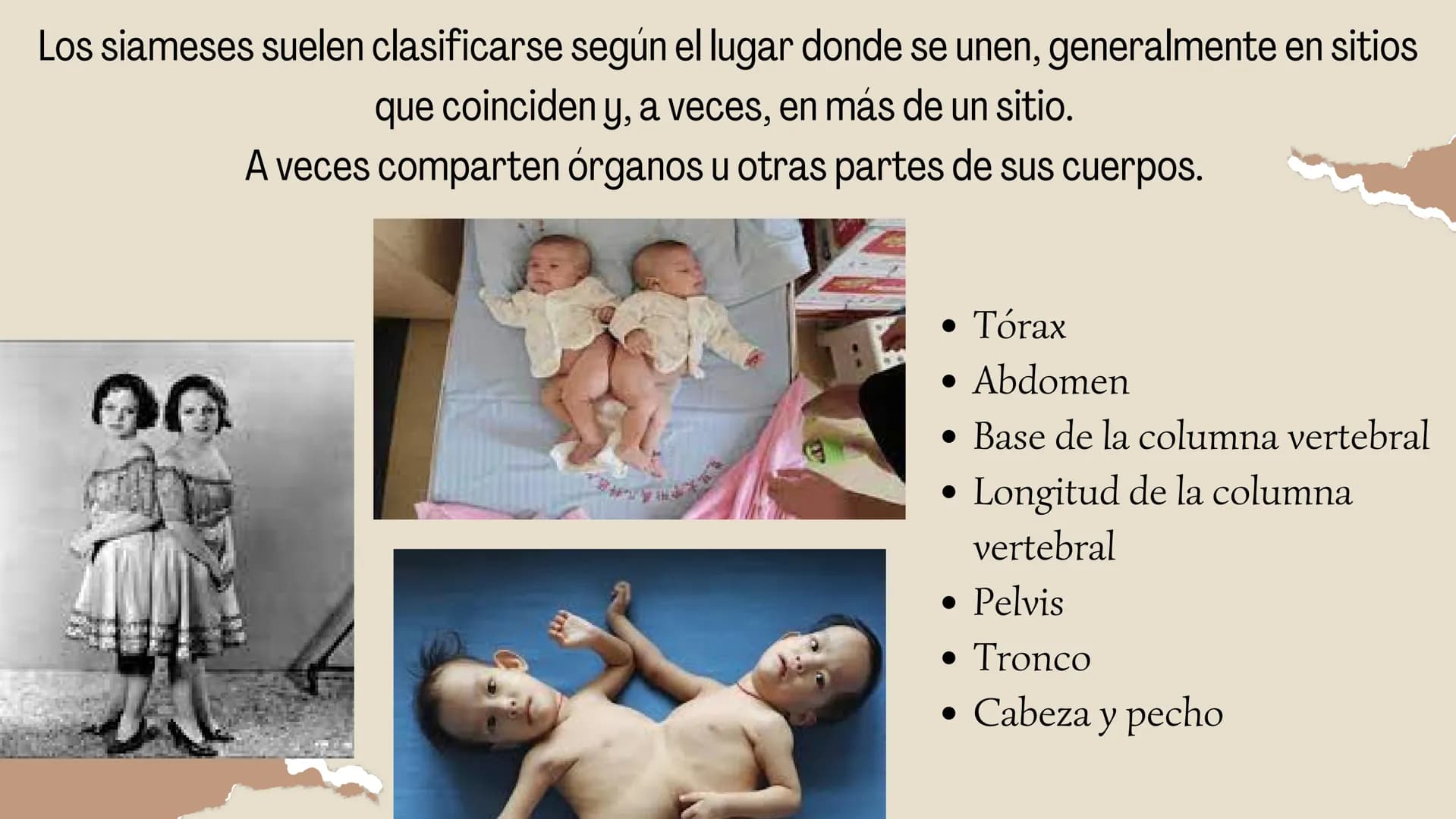 # HERMANOS

# SIAMESES

Septimo - 2022 # ¿QUE SON LOS HERMANOS
SIAMESES?

Los gemelos unidos son dos bebés que nacen conectados
físicamente.