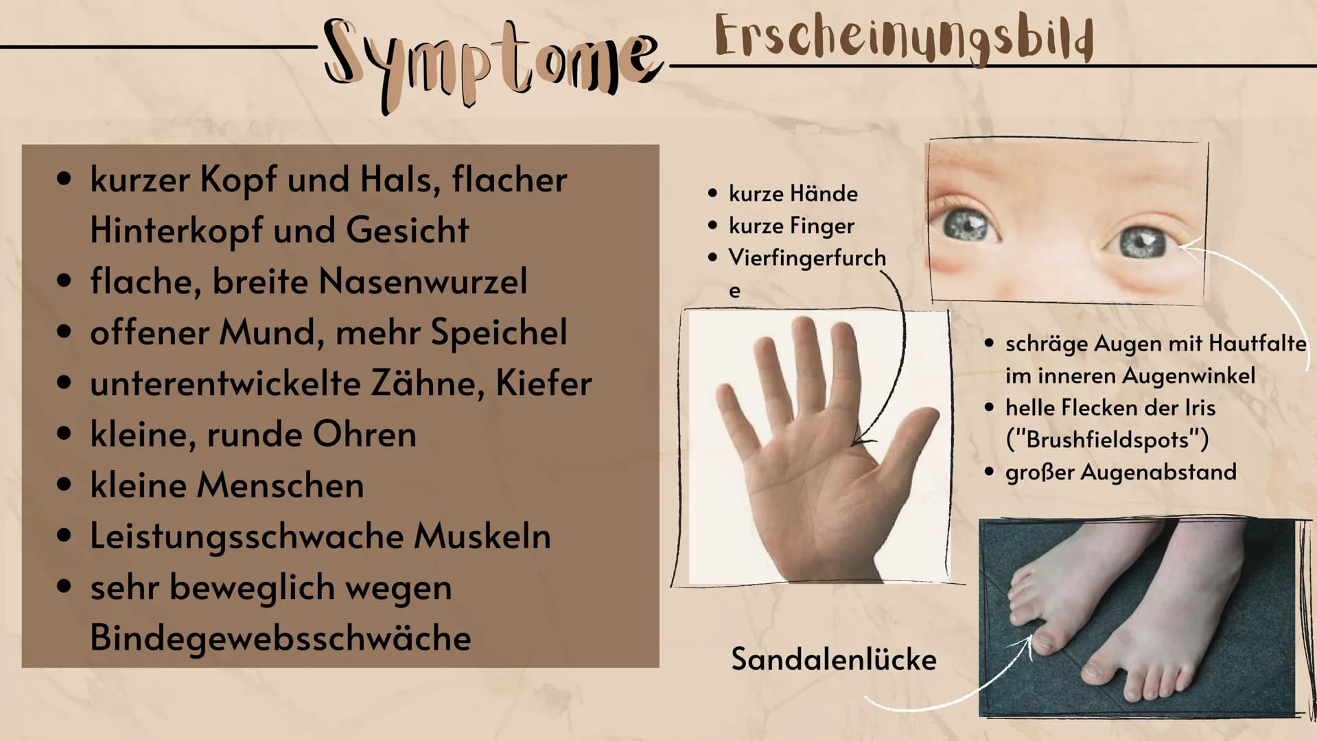 # Down-Syndrom

eine Erbkrankheit?

Präsentation
Sarah Keller
13.01.2021
BIO LK Gliederung

Was ist ein Syndrom?
Down-Syndrom- Ein Syndrom?
