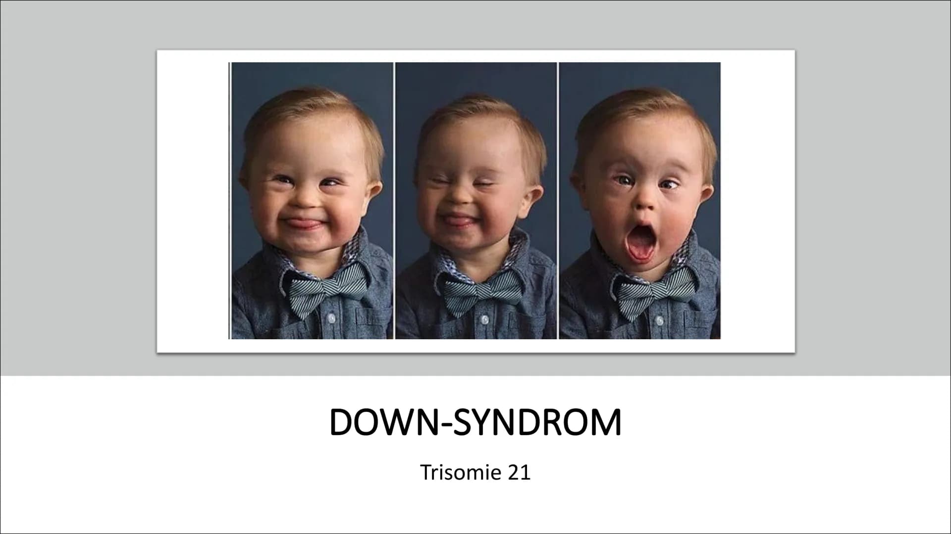 # DOWN-SYNDROM

Trisomie 21 • Was ist Trisomie 21?
• Entdeckung
• Ursache und Risikofaktoren
• Die drei unterschiedlichen Formen der Trisomi