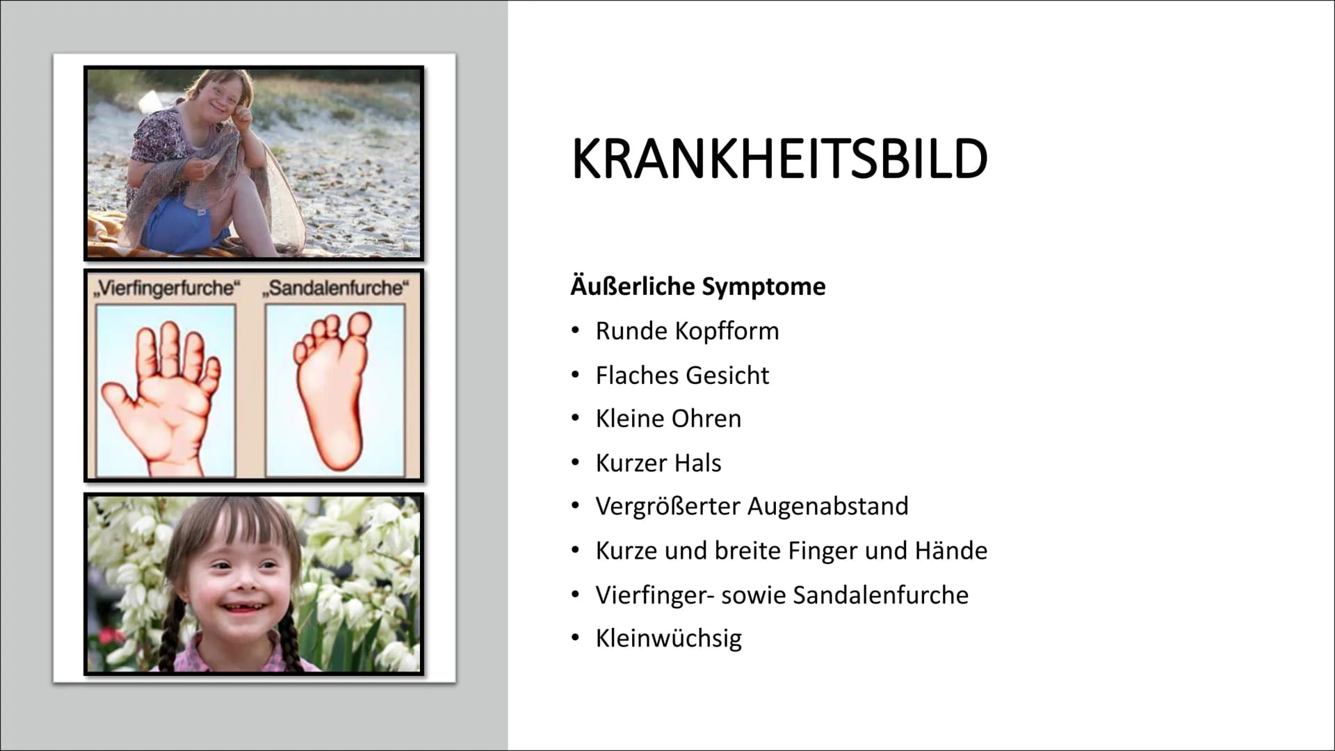 # DOWN-SYNDROM

Trisomie 21 • Was ist Trisomie 21?
• Entdeckung
• Ursache und Risikofaktoren
• Die drei unterschiedlichen Formen der Trisomi