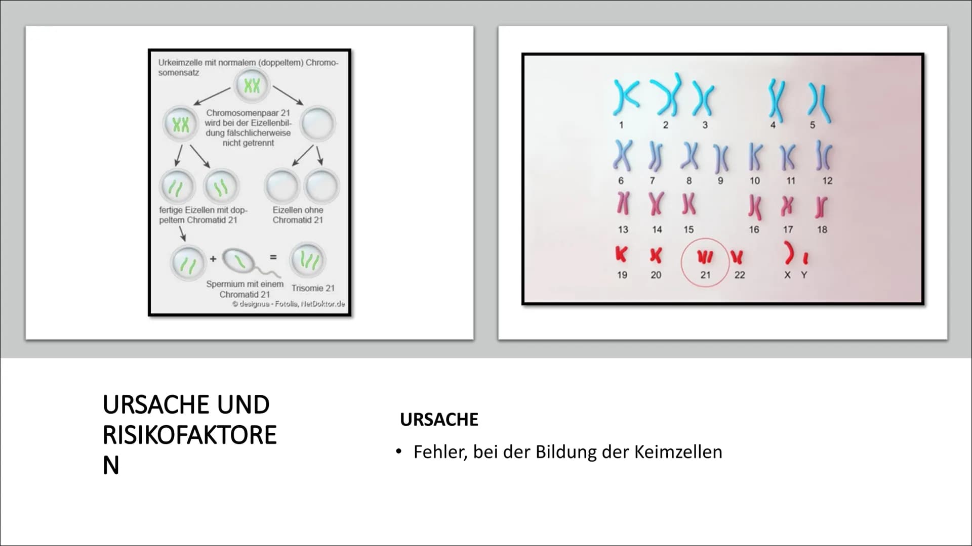 # DOWN-SYNDROM

Trisomie 21 • Was ist Trisomie 21?
• Entdeckung
• Ursache und Risikofaktoren
• Die drei unterschiedlichen Formen der Trisomi