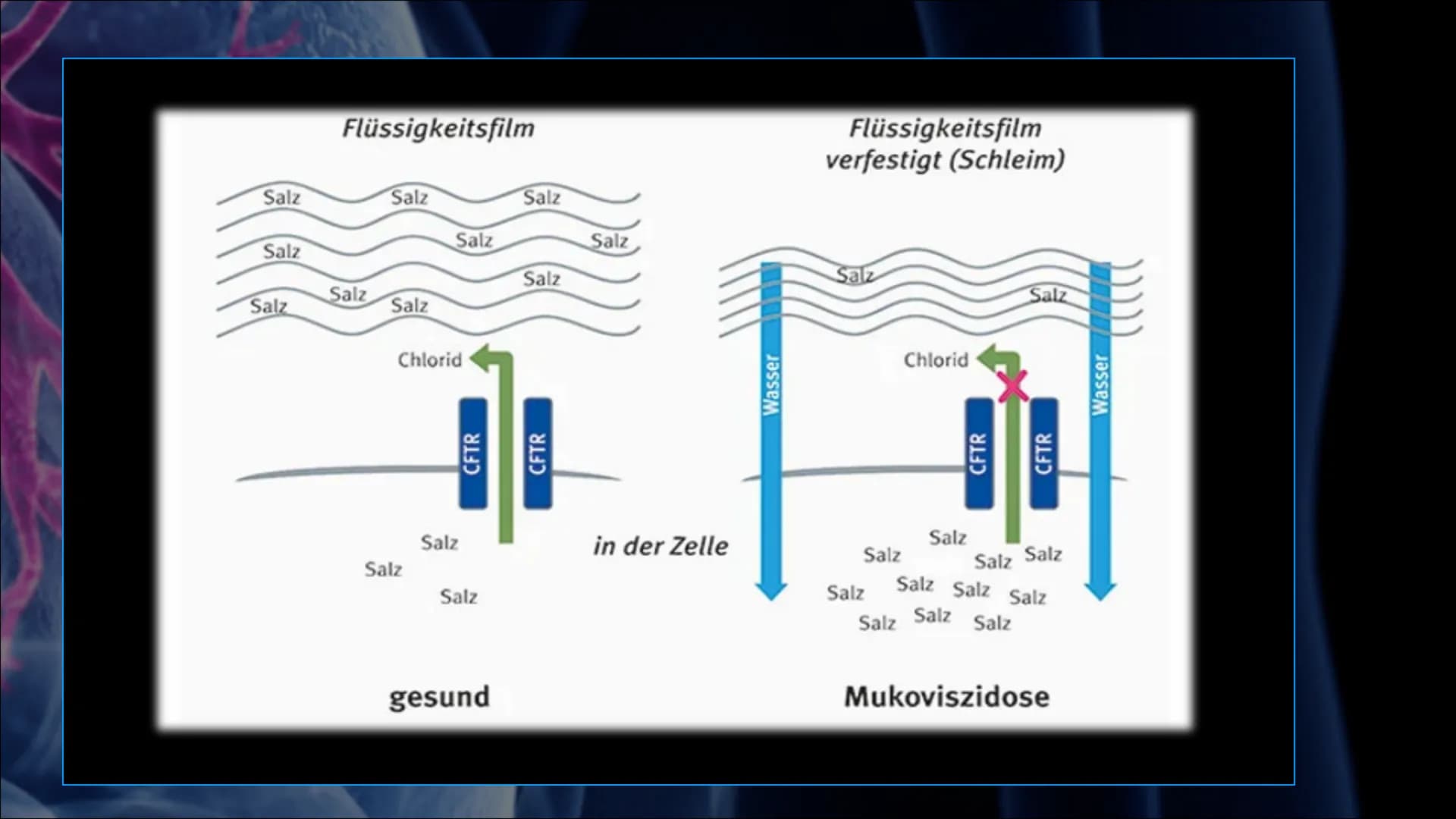 Mukoviszidose # Inhalt
• Was ist Mukoviszidose?
• Ursachen
• Genetische Vererbung
• Symptome
• Diagnoseverfahren
• Behandlungsmöglichkeiten