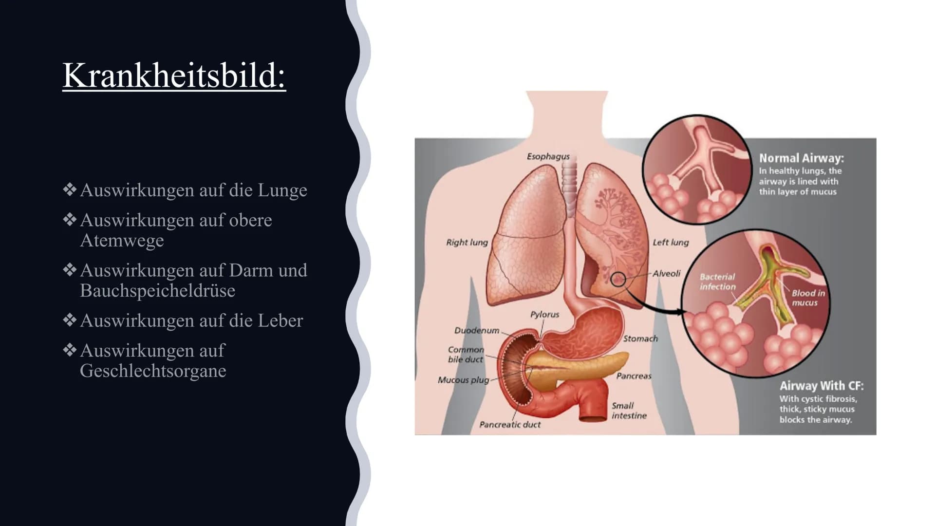 # Mukoviszidose
Von Celine und Nisa Gliederung:
◆Definition
◆Symptome
◆Ursachen
Krankheitsbild
◆Vererbung
◆Lebenserwartung/Vorkommen
◆Die